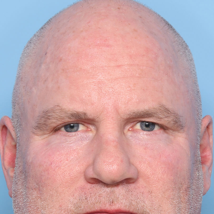 Case--33124 | After Blepharoplasty