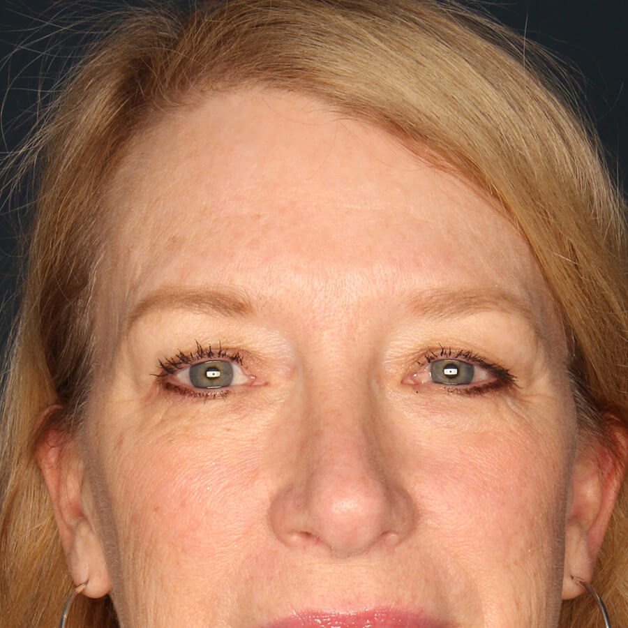 Case--33224 | Before Blepharoplasty