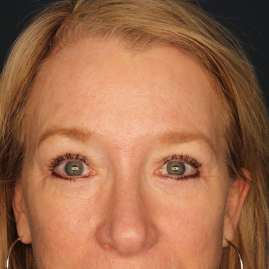 Case--33224 | After Blepharoplasty