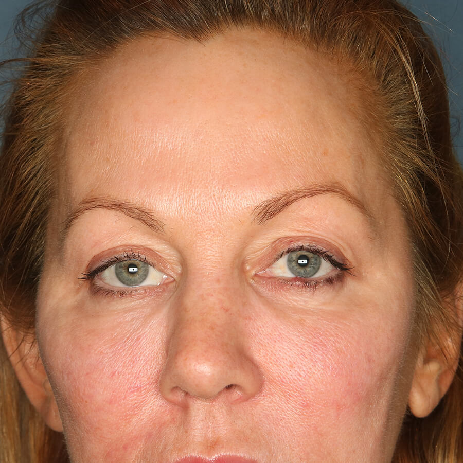 Case--33324 | Before Blepharoplasty