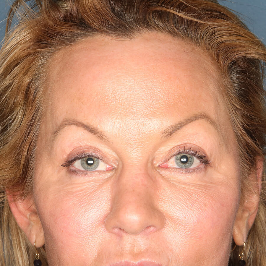 Case--33324 | After Blepharoplasty