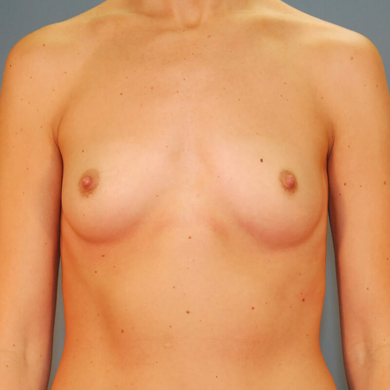 Case--3424 | Before Breast Augmentation