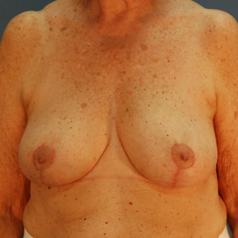 Case--35624 | After Cosmetic Breast Surgery