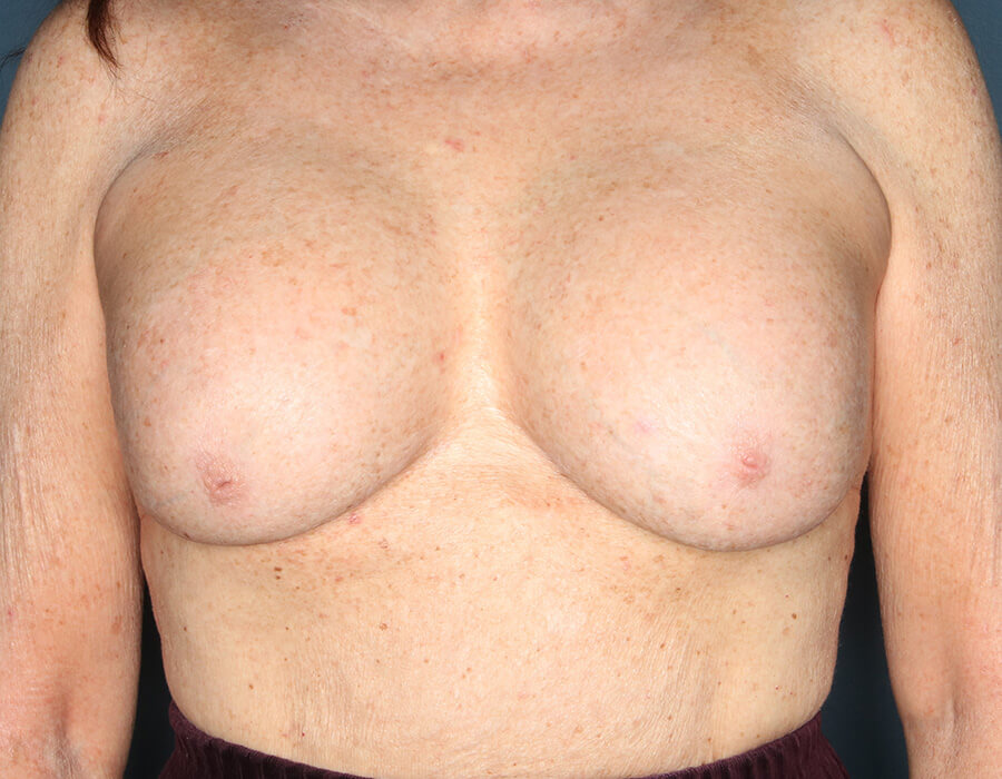 Case--36124 | Before Cosmetic Breast Surgery