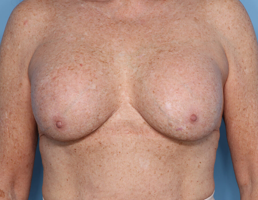 Case--36124 | After Cosmetic Breast Surgery