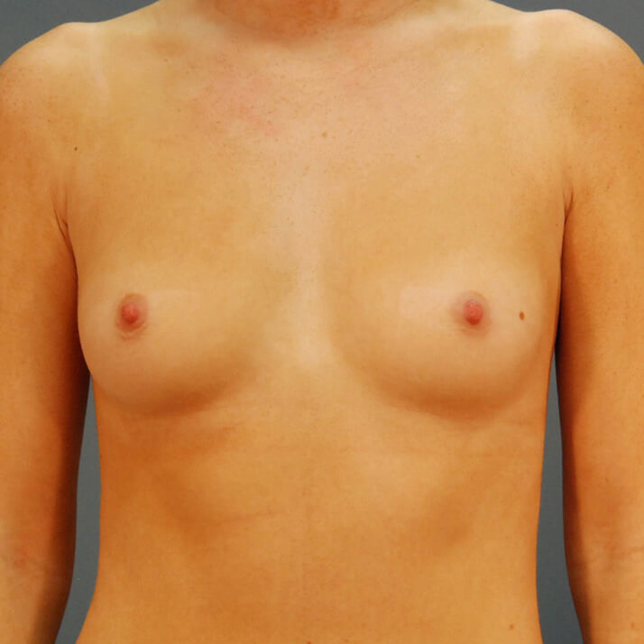 Case--4724 | Before Breast Augmentation