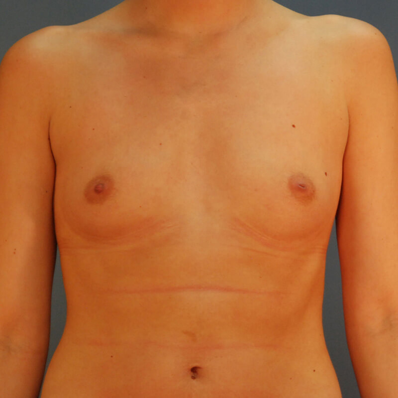 Case--4824 | Before Breast Augmentation