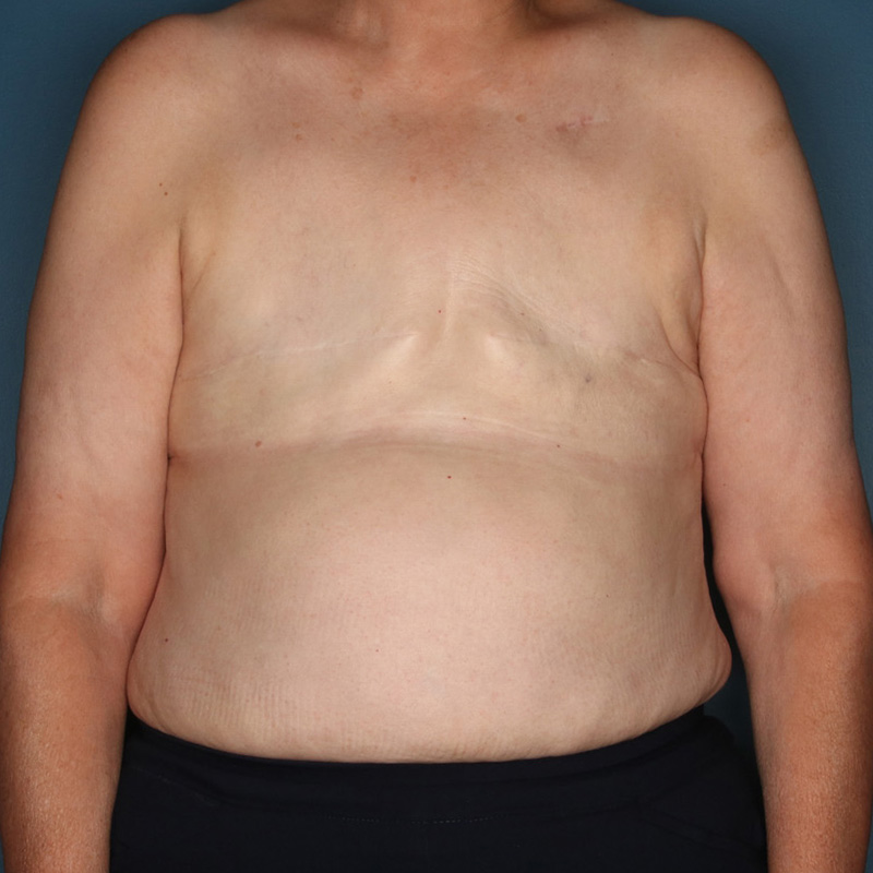 Case--50023 | Before Delayed Breast Reconstruction