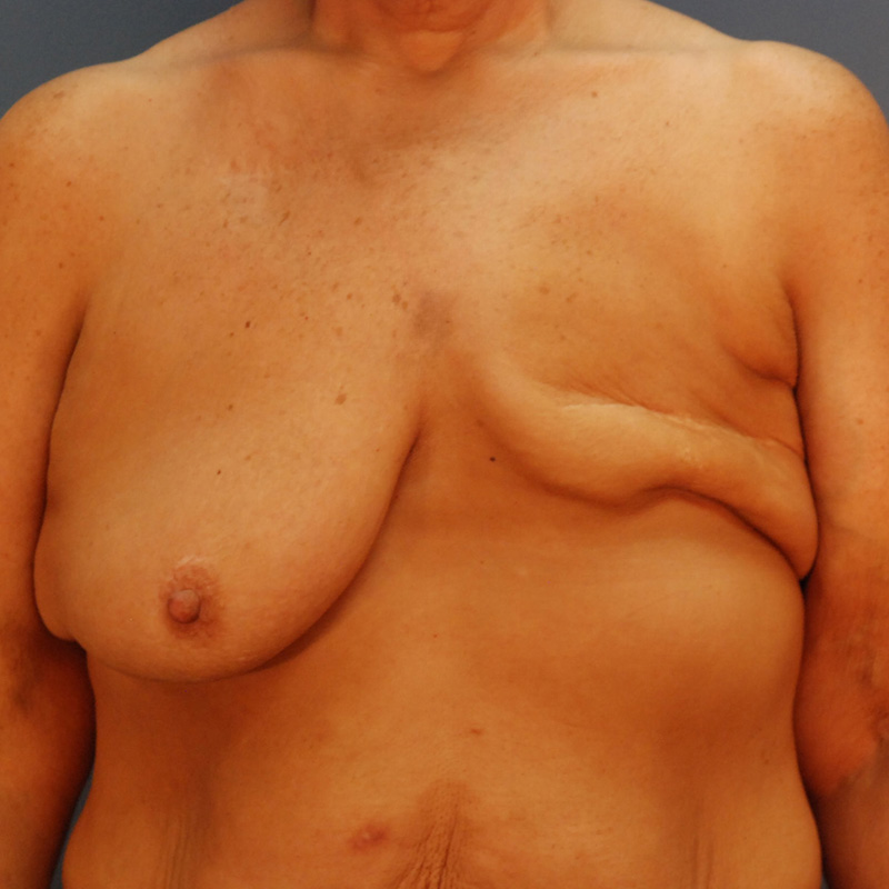 Case--50123 | Before Delayed Breast Reconstruction