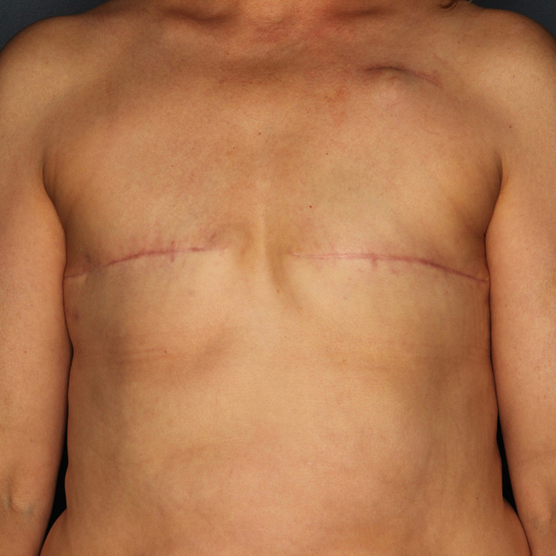 Case--50223 | Before Delayed Breast Reconstruction