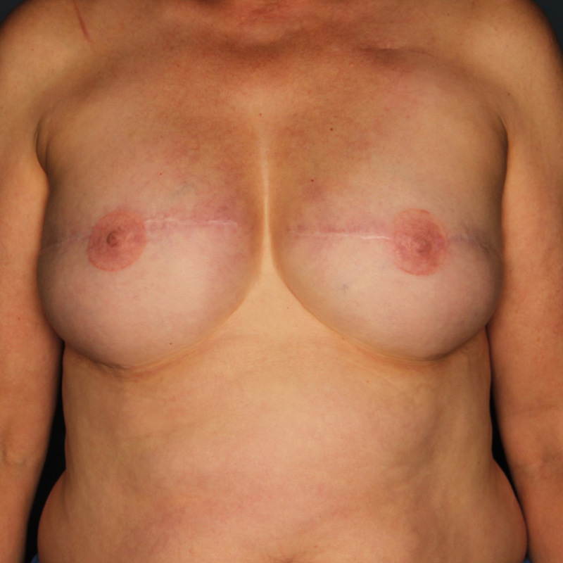 Case--50223 | After Delayed Breast Reconstruction