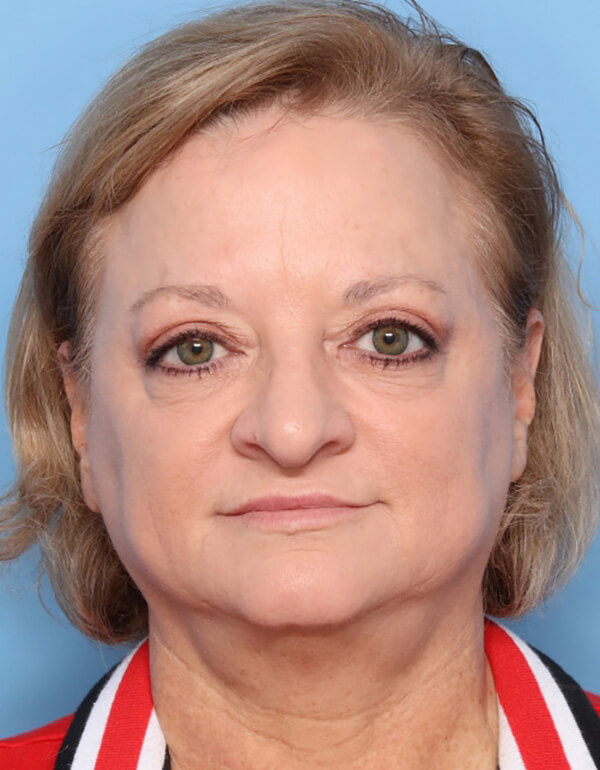 Case--2488 | Before Facelift