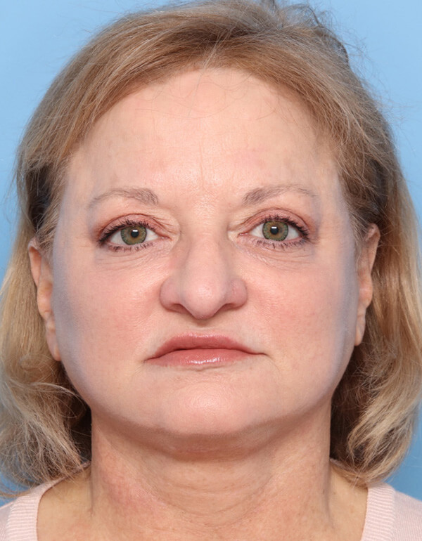 Case--2488 | After Facelift