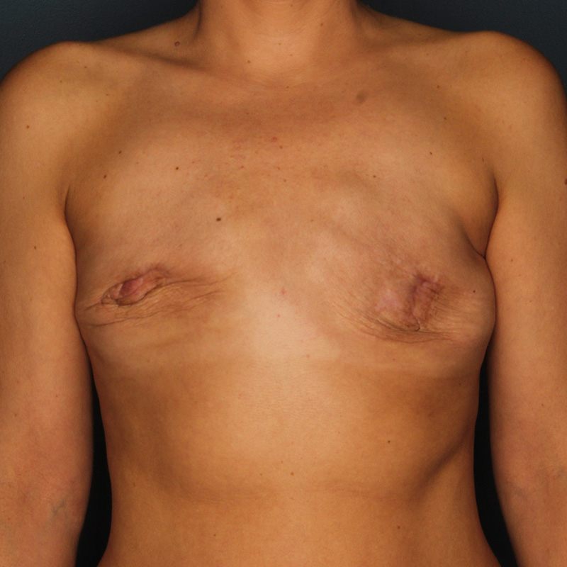 Case--50423 | Before Delayed Breast Reconstruction