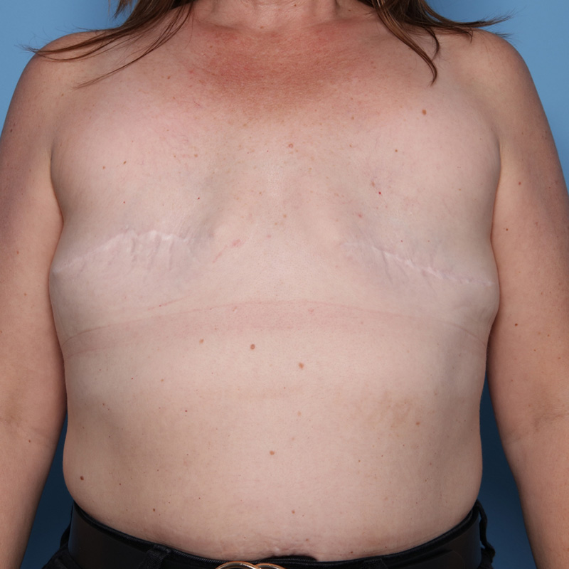 Case--50523 | Before Delayed Breast Reconstruction