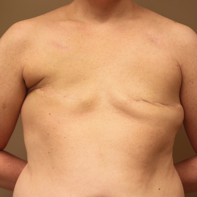 Case--50623 | Before Delayed Breast Reconstruction