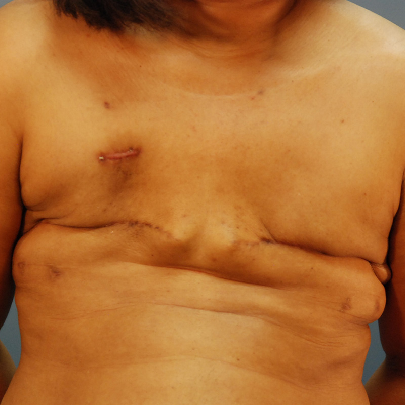 Case--50723 | Before Delayed Breast Reconstruction