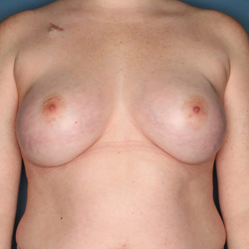 Case--51623 | Before Implant-Based Nipple Sparing Reconstruction