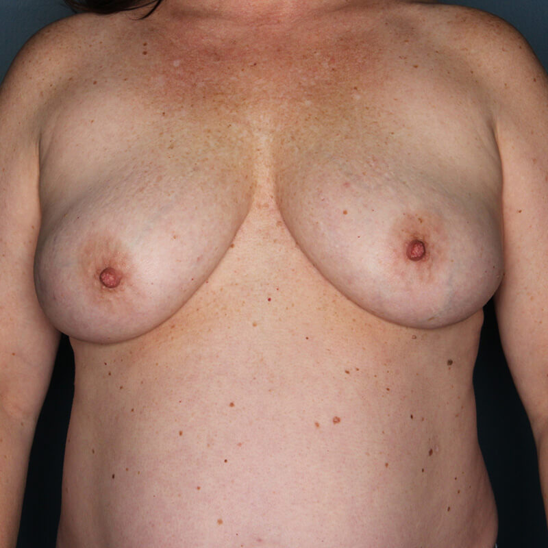 Case--51723 | Before Reconstructive Breast Surgery