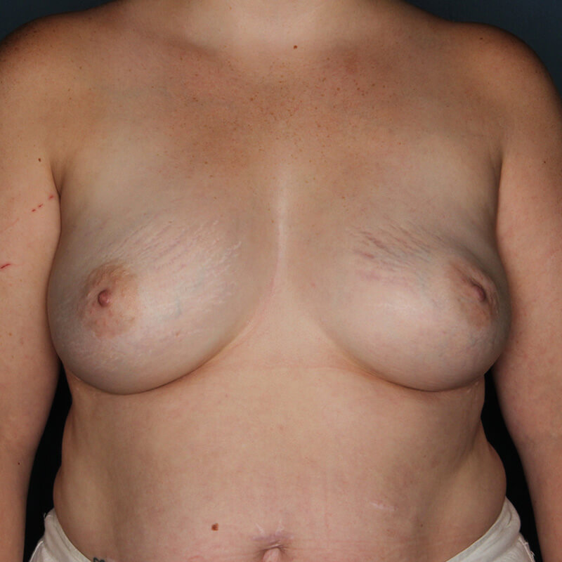 Case--52323 | After Reconstructive Breast Surgery