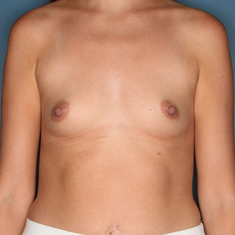 Case--52523 | Before Implant-Based Nipple Sparing Reconstruction