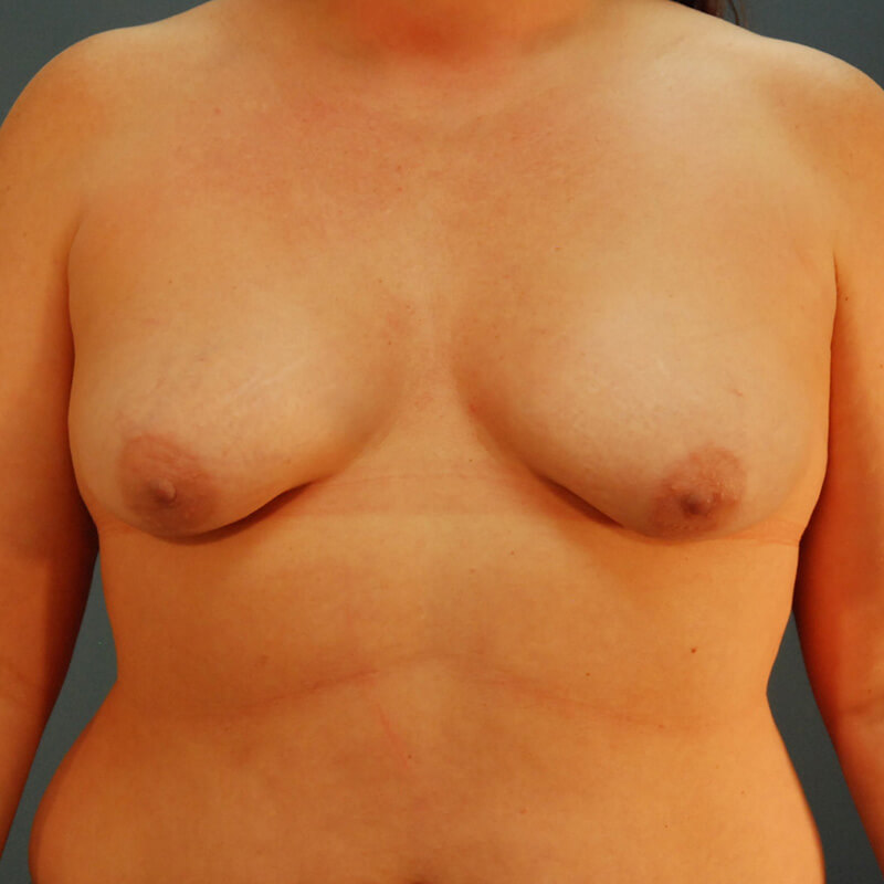 Case--53223 | Before Reconstructive Breast Surgery