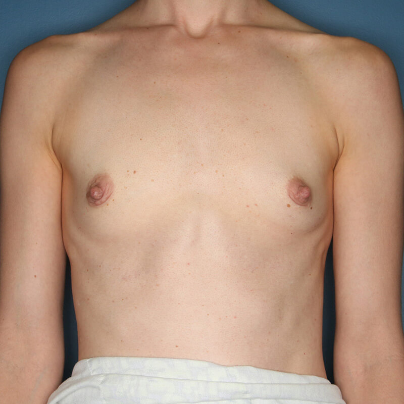 Case--5324 | Before Breast Augmentation
