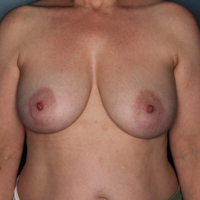 Case--53623 | Before Implant-Based Nipple Sparing Reconstruction
