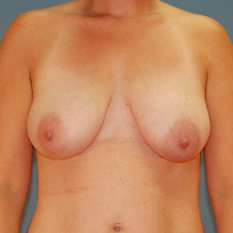 Case--7524 | Before Cosmetic Breast Surgery