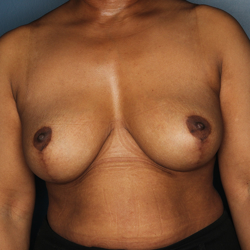Case--9624 | After Breast Reduction with Lift