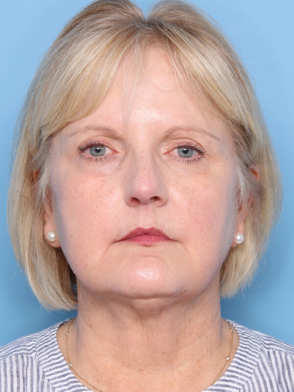 Case--9543 | Before Facelift