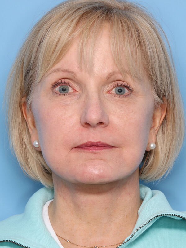 Case--9543 | After Facelift