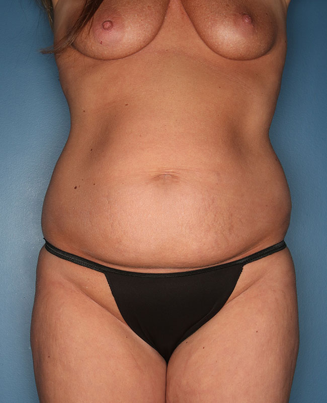 Case--32324 | Before Abdominoplasty