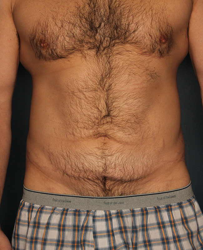 Case--32224 | Before Abdominoplasty