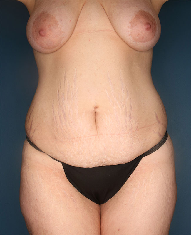 Case--32124 | Before Abdominoplasty