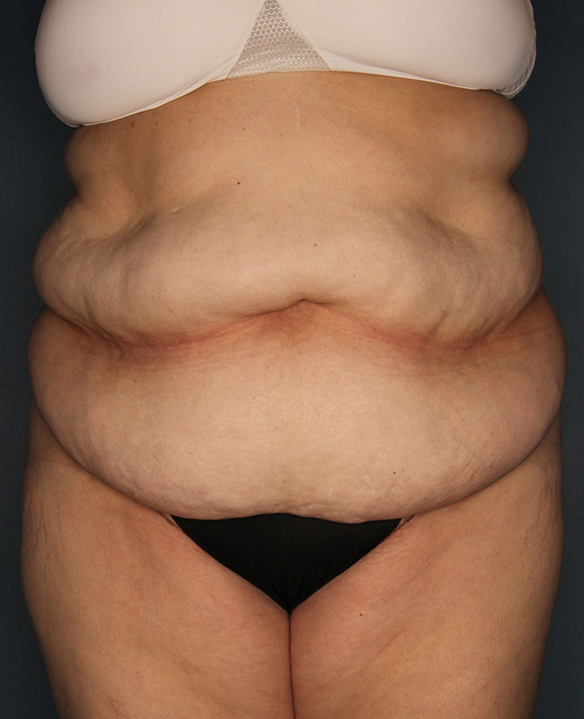 Case--31924 | Before Abdominoplasty