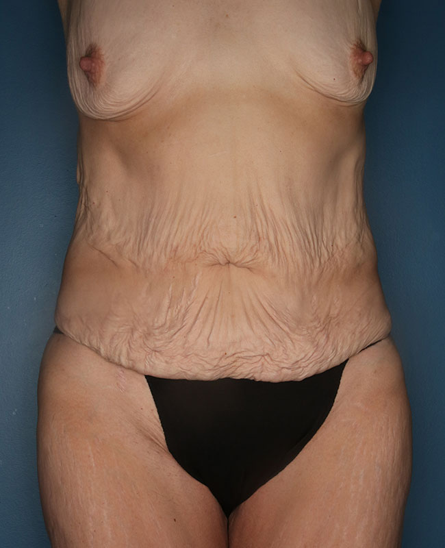 Case--31824 | Before Abdominoplasty