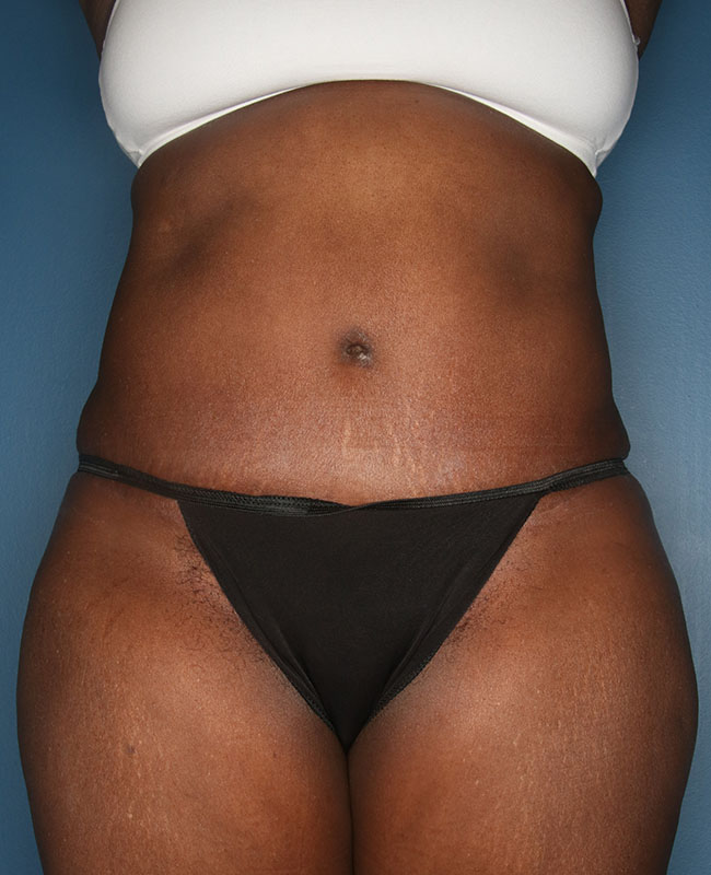 Case--31724 | After Abdominoplasty