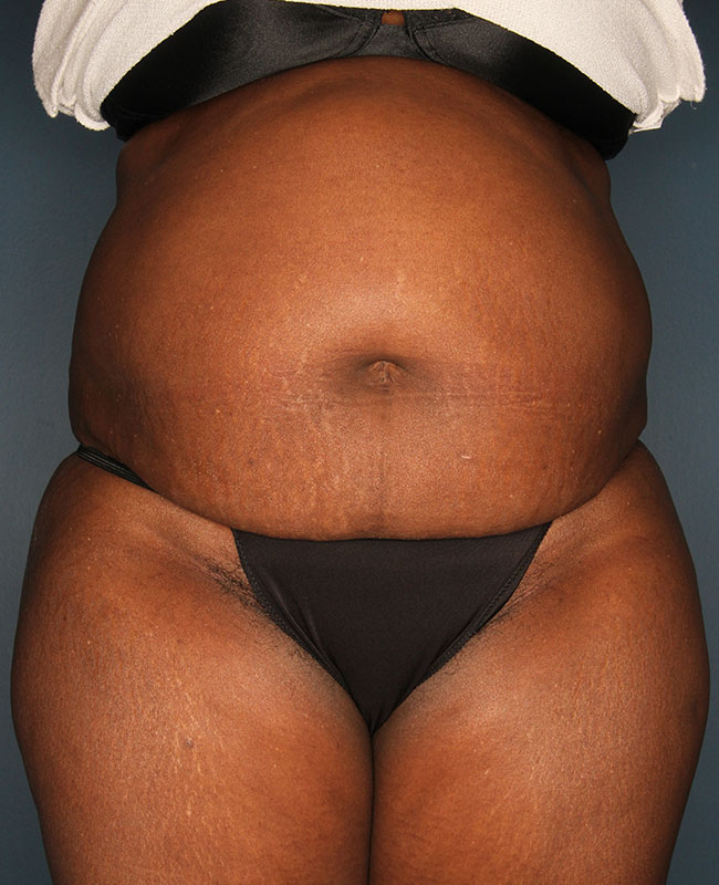 Case--31724 | Before Abdominoplasty