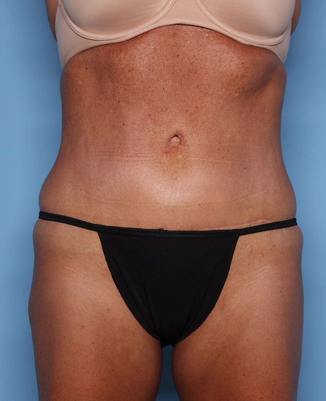 Case--31624 | After Abdominoplasty