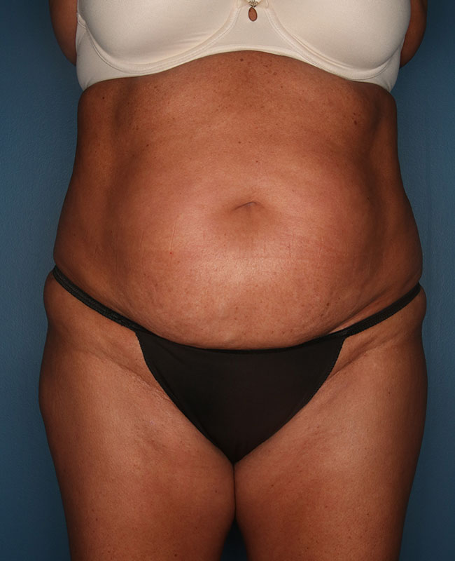 Case--31624 | Before Abdominoplasty