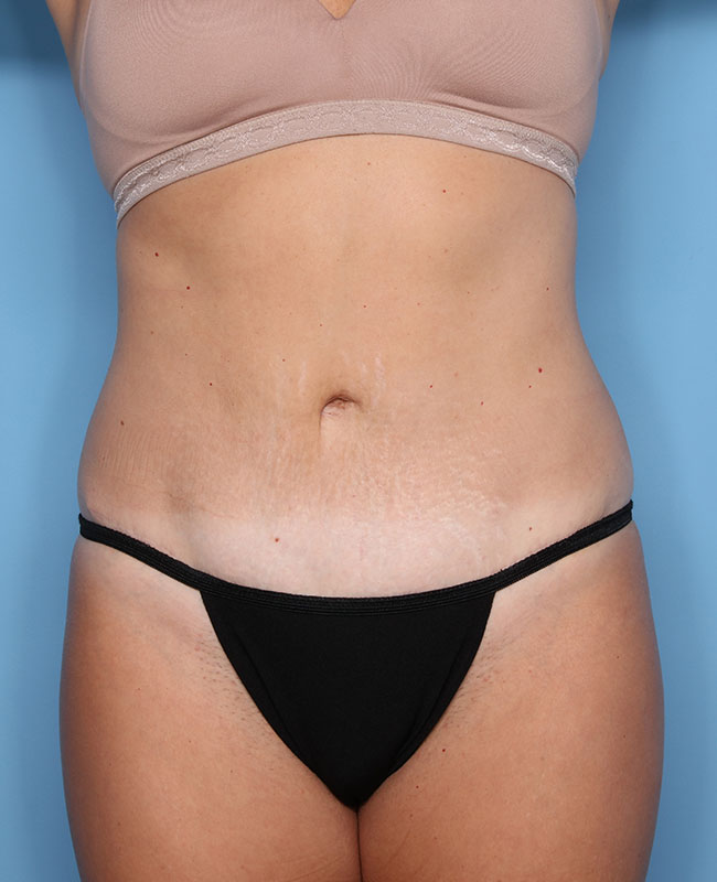 Case--31424 | After Abdominoplasty