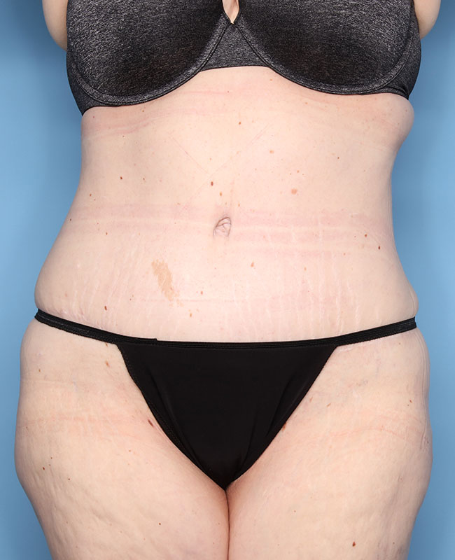 Case--31324 | After Abdominoplasty