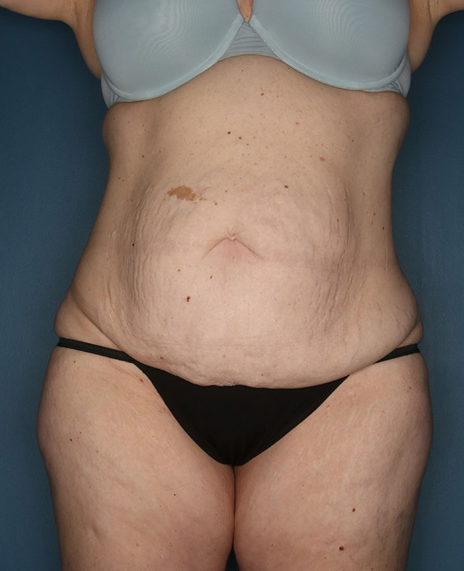 Case--31324 | Before Abdominoplasty
