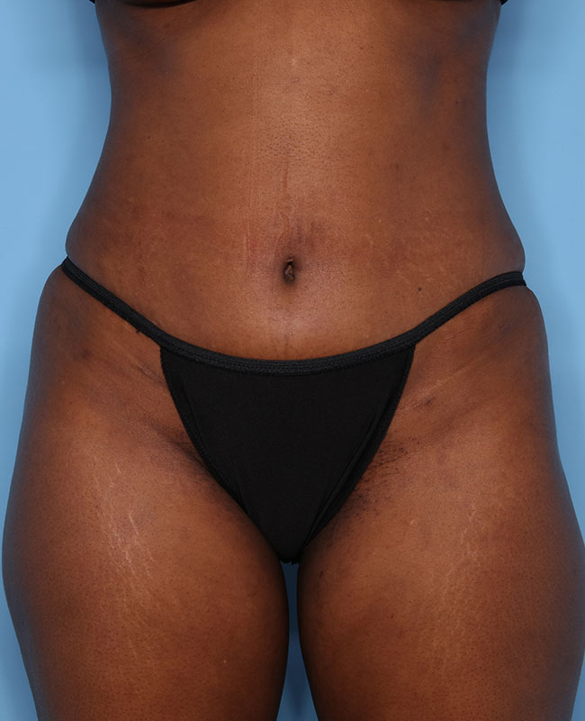 Case--31224 | After Abdominoplasty