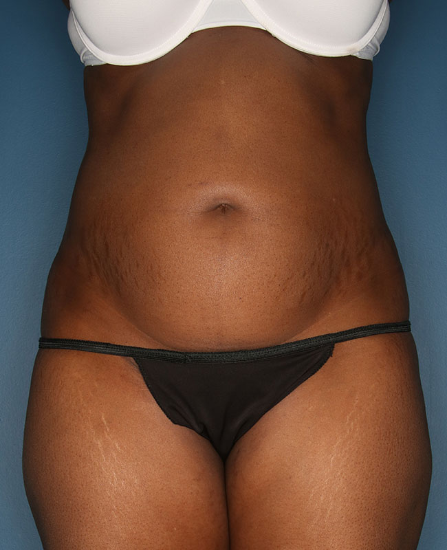 Case--31224 | Before Abdominoplasty