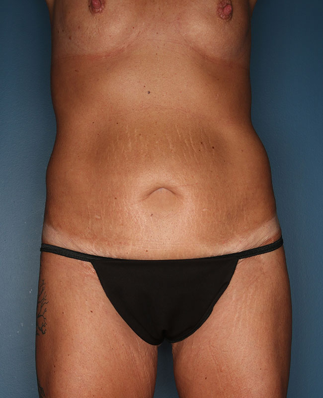Case--31124 | Before Abdominoplasty