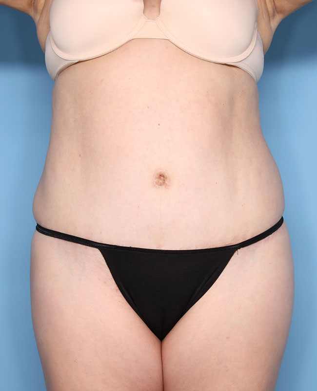 Case--30824 | After Abdominoplasty