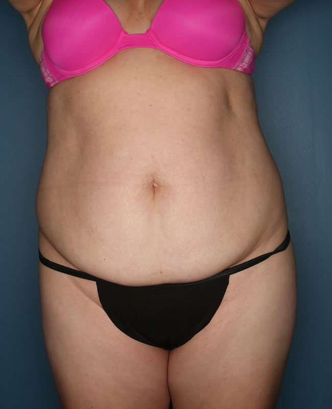 Case--30824 | Before Abdominoplasty