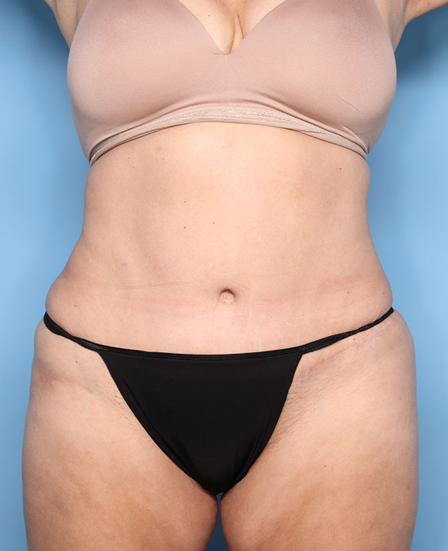 Case--30624 | After Abdominoplasty